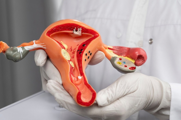 Uterine Fibroid Treatment